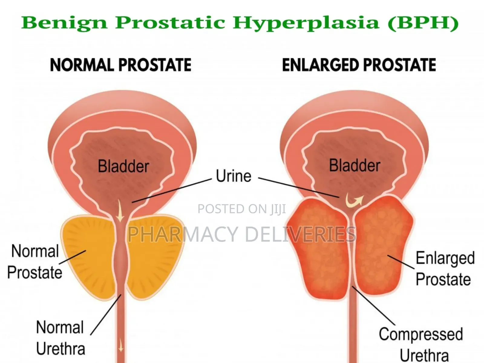 Prostate Growth Treatment With Natural Supplement Available