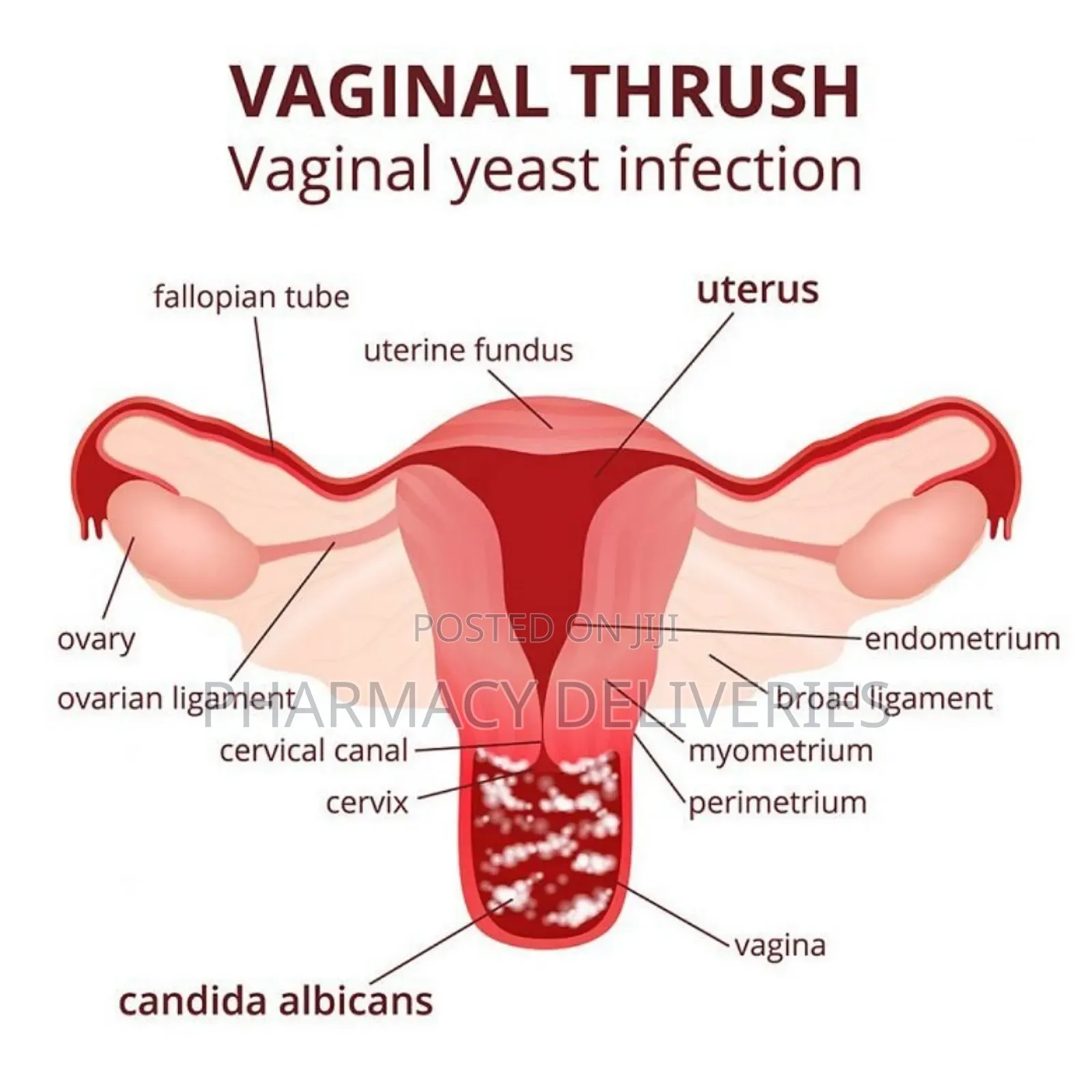 Treatment of Candidiasis Bacteria, Fungi and Yeast Infection