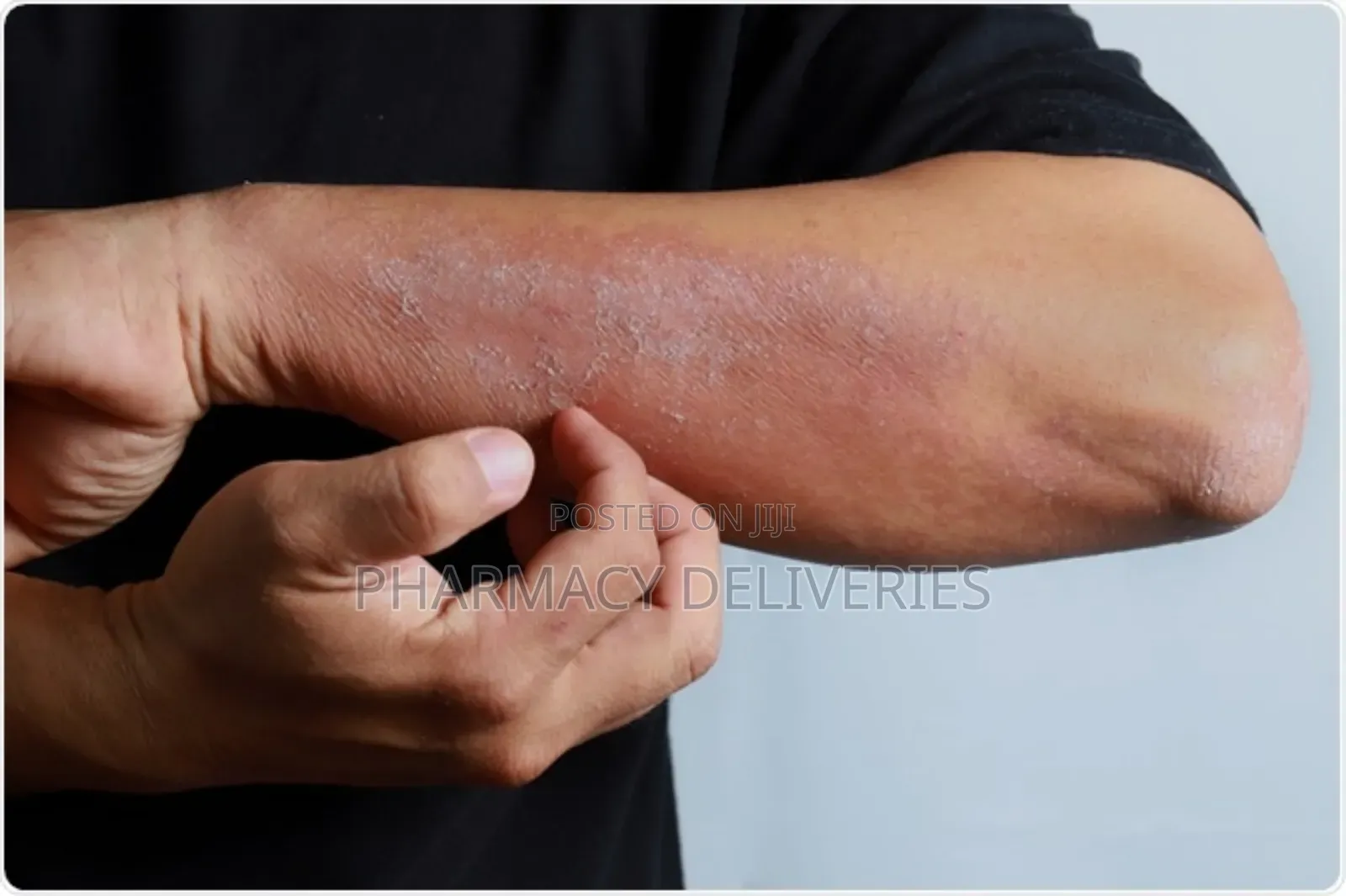 Treatment For Skin Parasitic Infection And Scabies Available