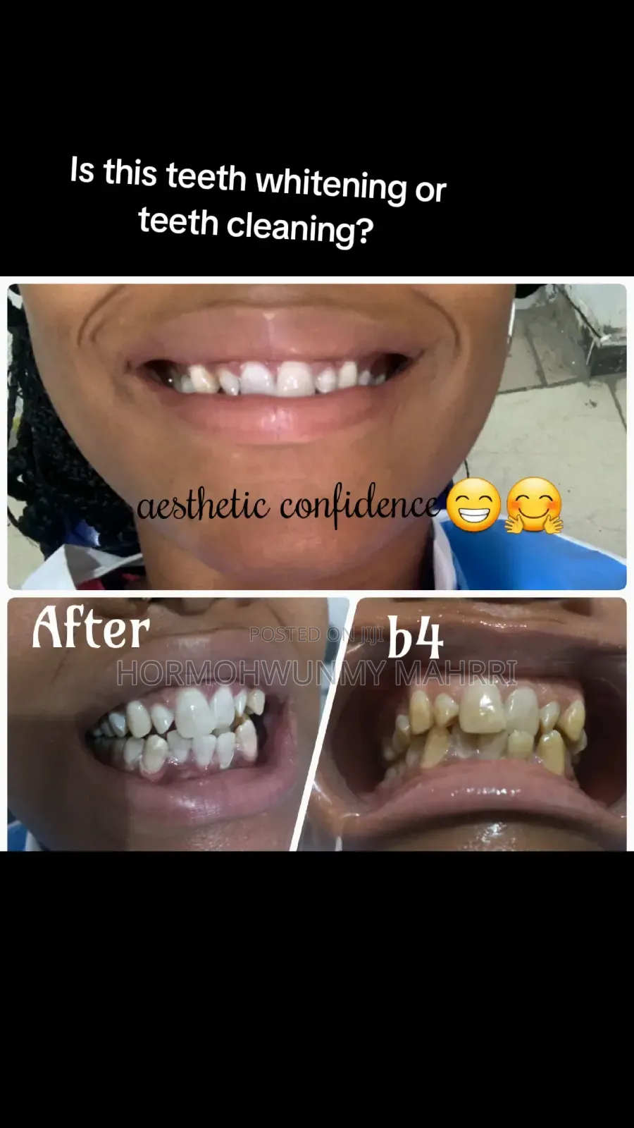 Home Service Teeth Whitening