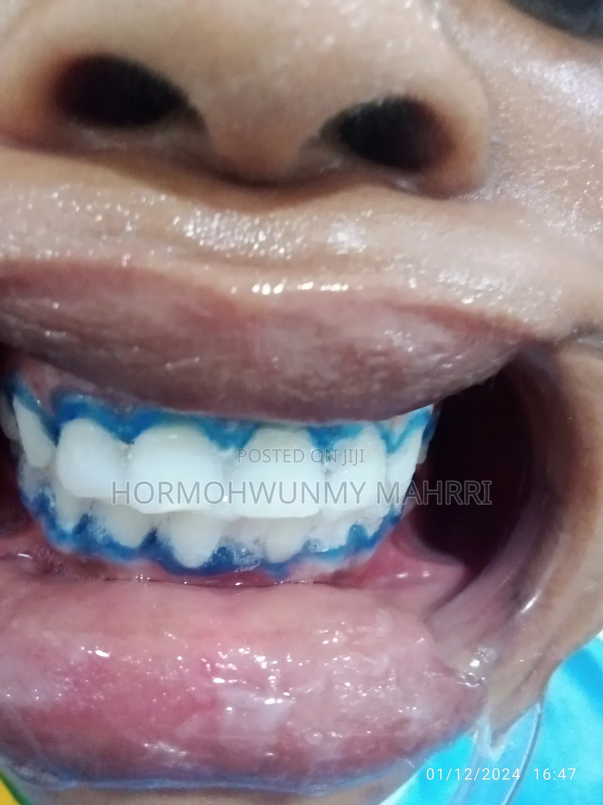 Home Service Teeth Whitening