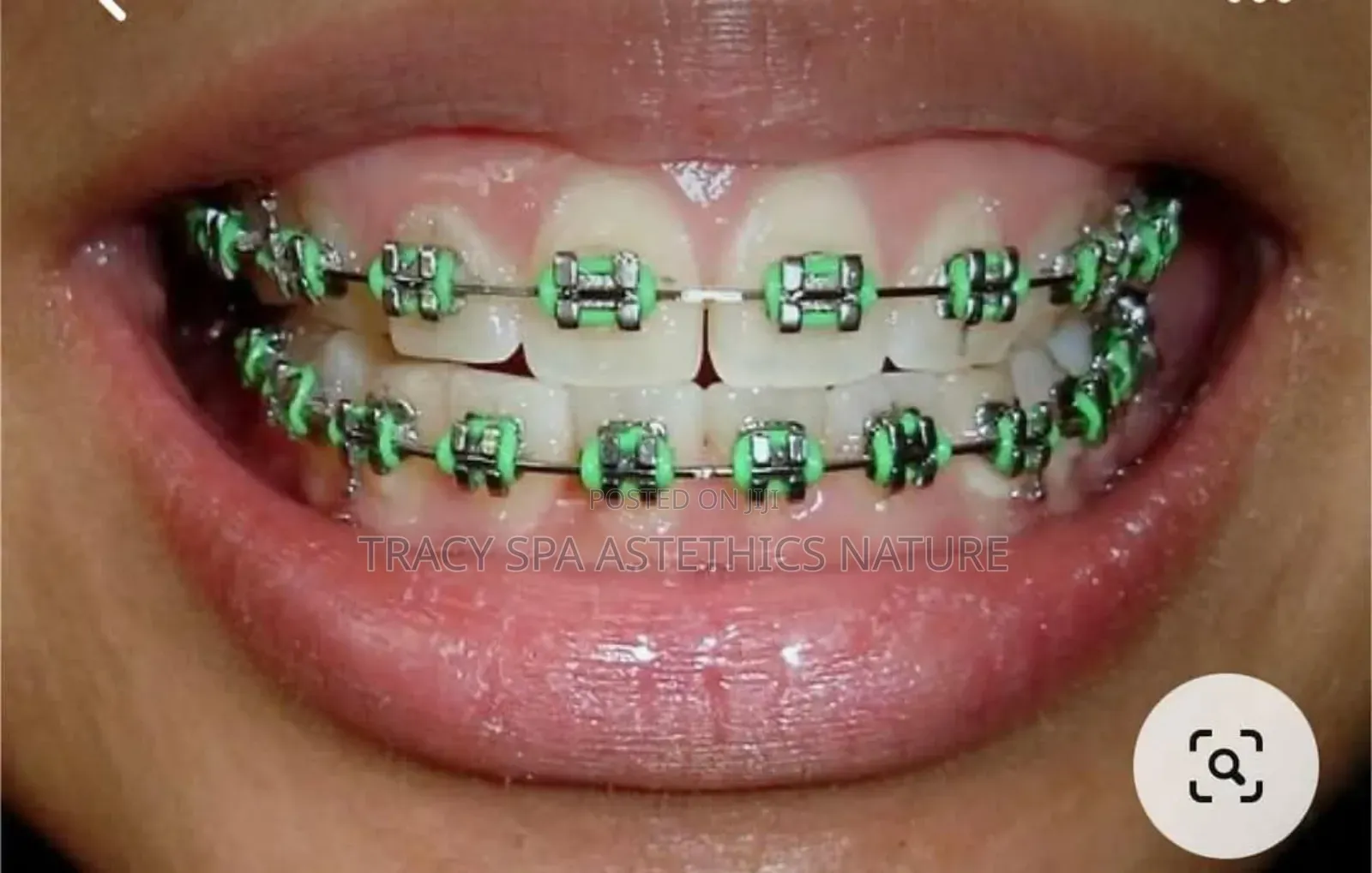BRACES Fas
