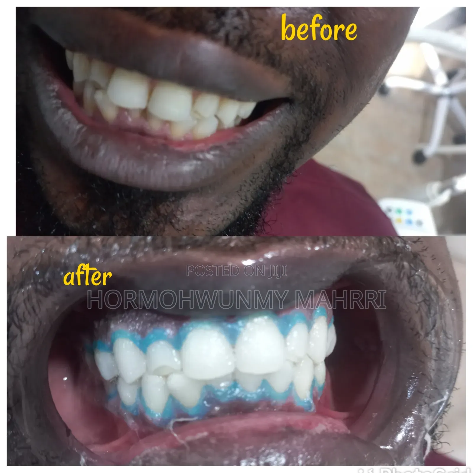 Laser Teeth Whitening