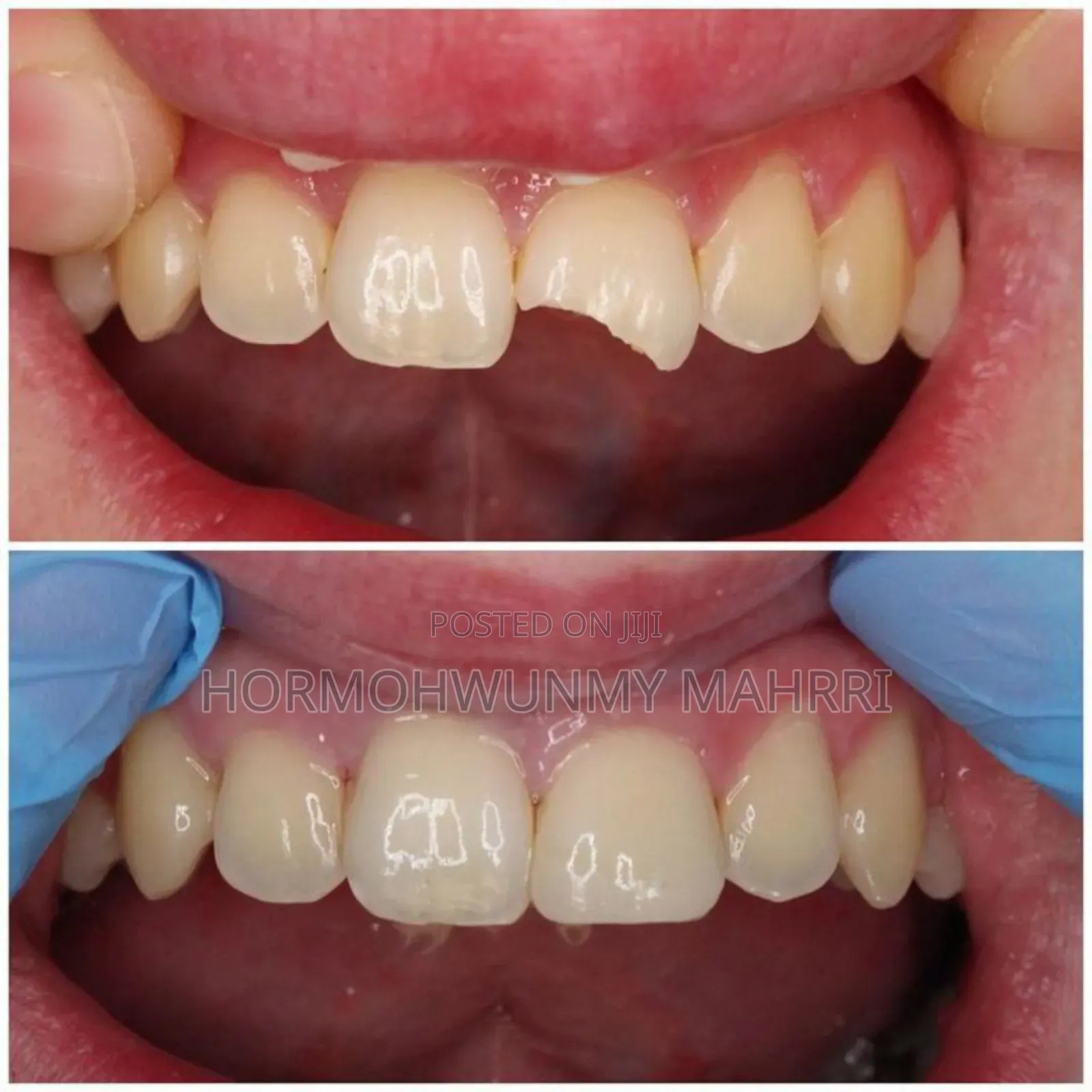 Teeth Filling