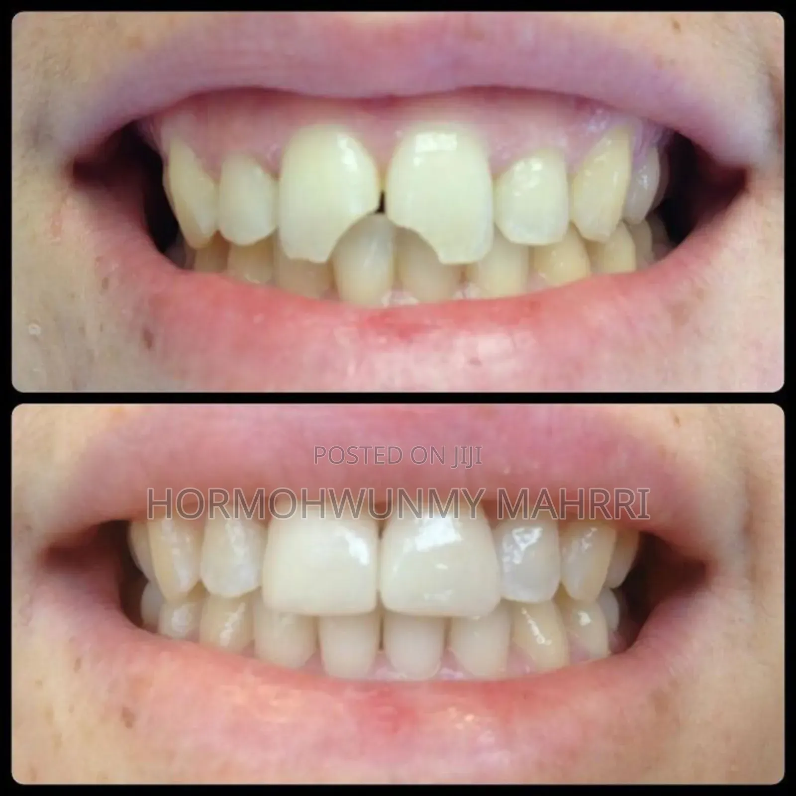 Teeth Filling