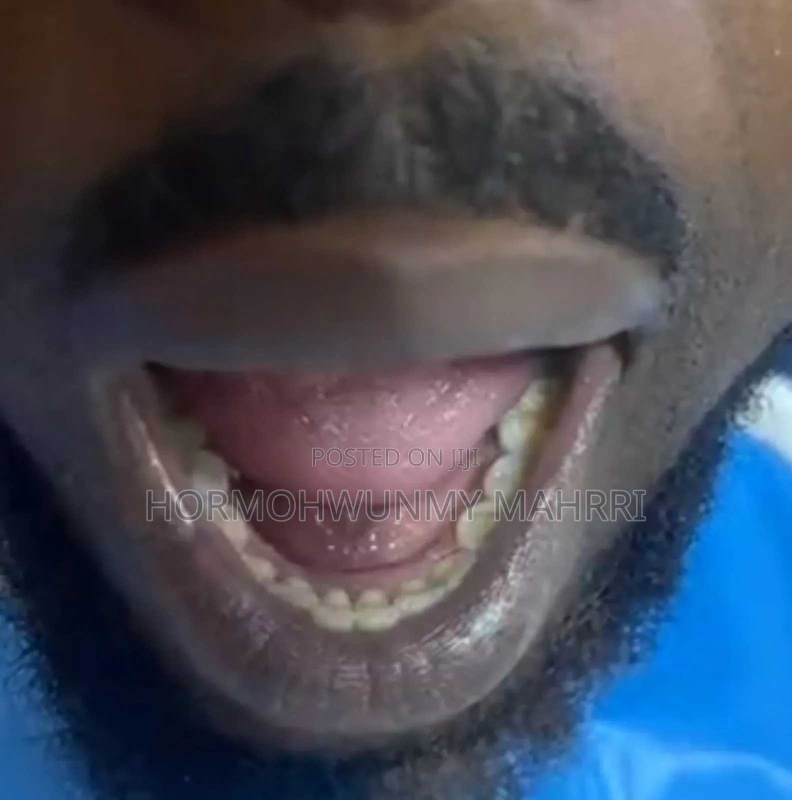 Teeth Stain Removal
