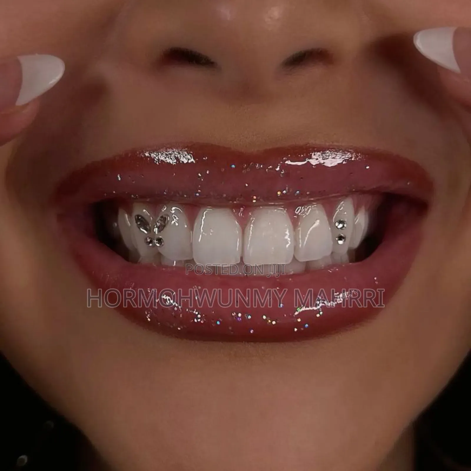 Tooth Gem Fixing
