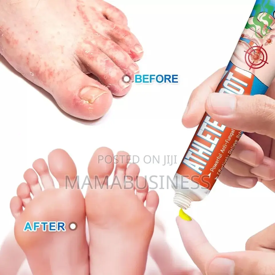 Sumifun Athlete's Foot Cream - 20g