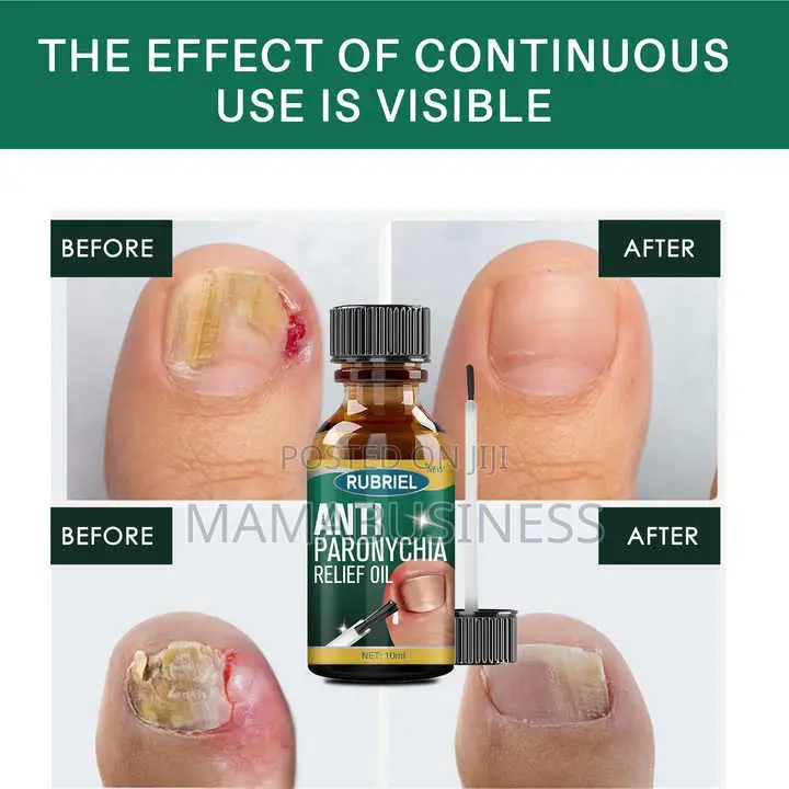 Rubriel Anti Paronychia Relief Oil -10ml