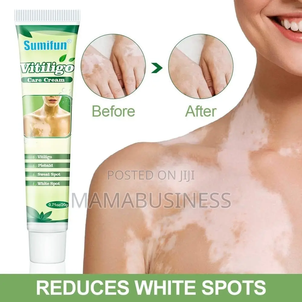Sumifun Vitiligo Care Cream - 20g