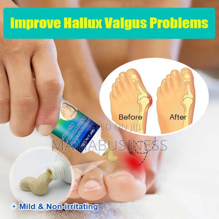 Kanyehb Bunion Pain Relief Cream - 20g