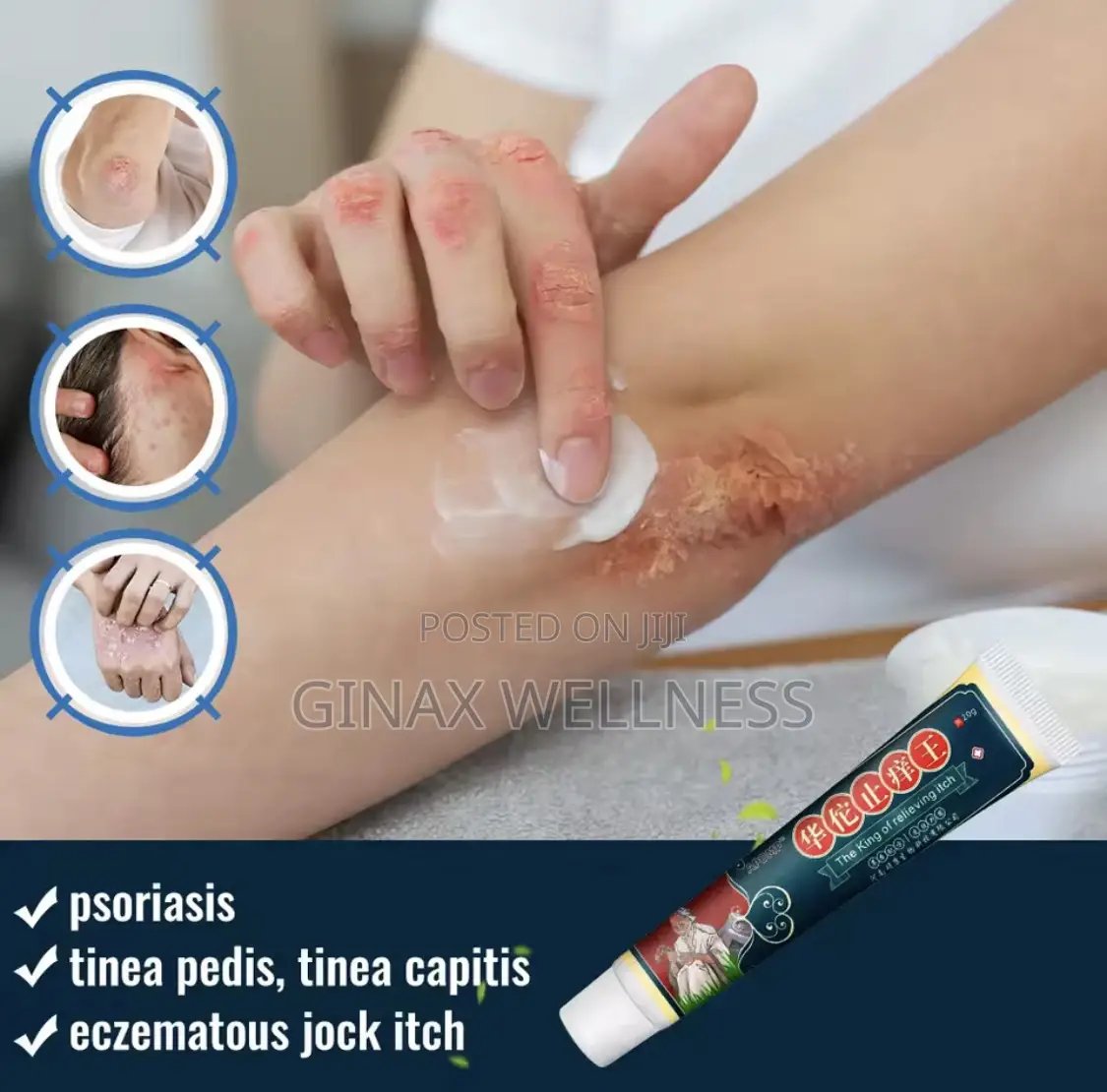 Itching Relief Cream - The King Of Relieving Itch