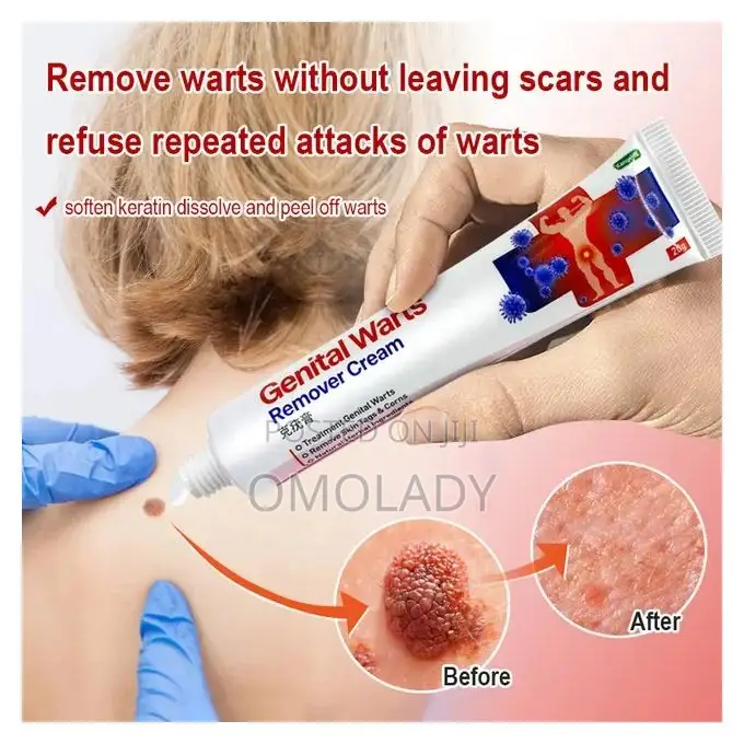 Kanyehb Effective Genital Wart Remover Cream - 20g