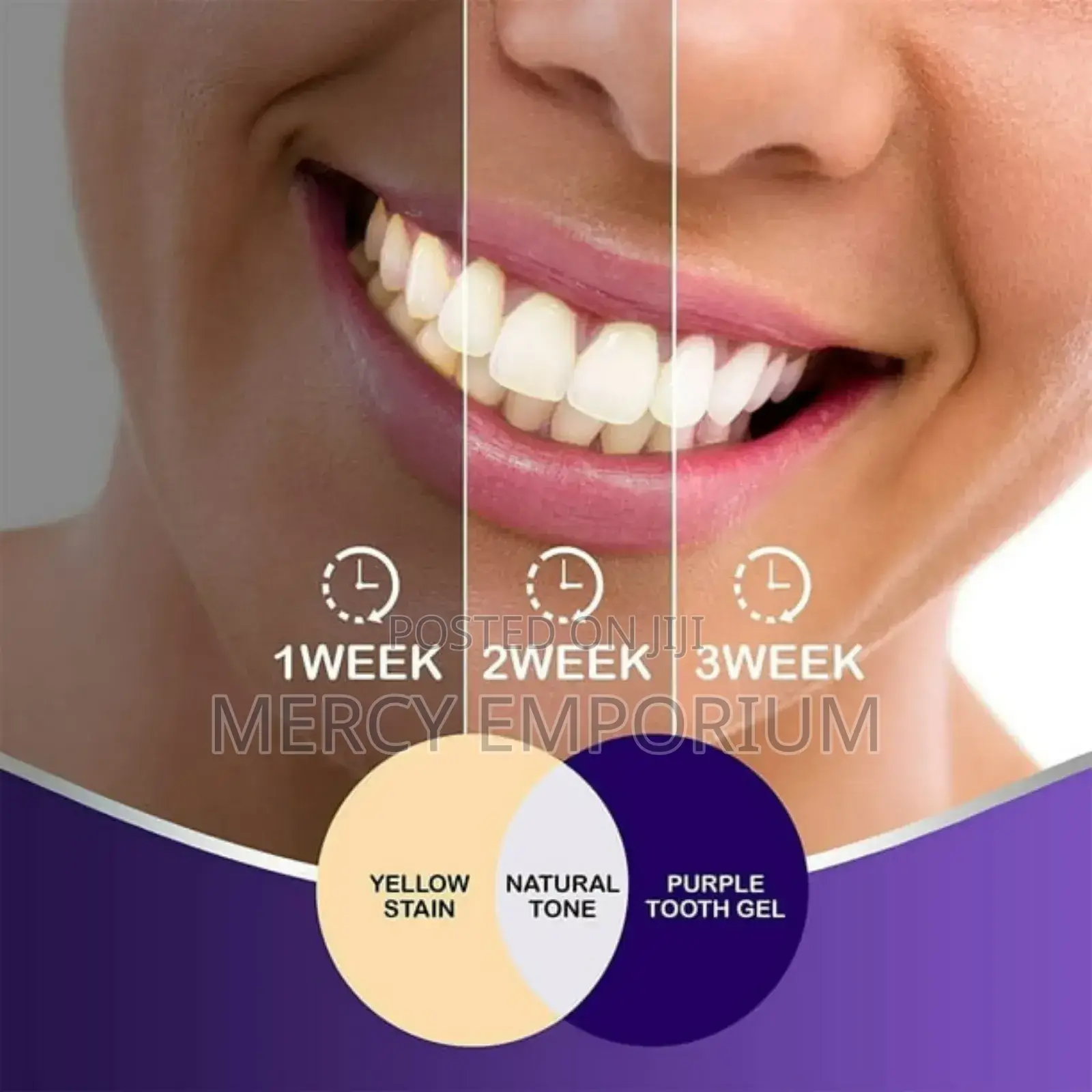 Hismile V34 Color Corrector. Purple Tooth Stain Concealer
