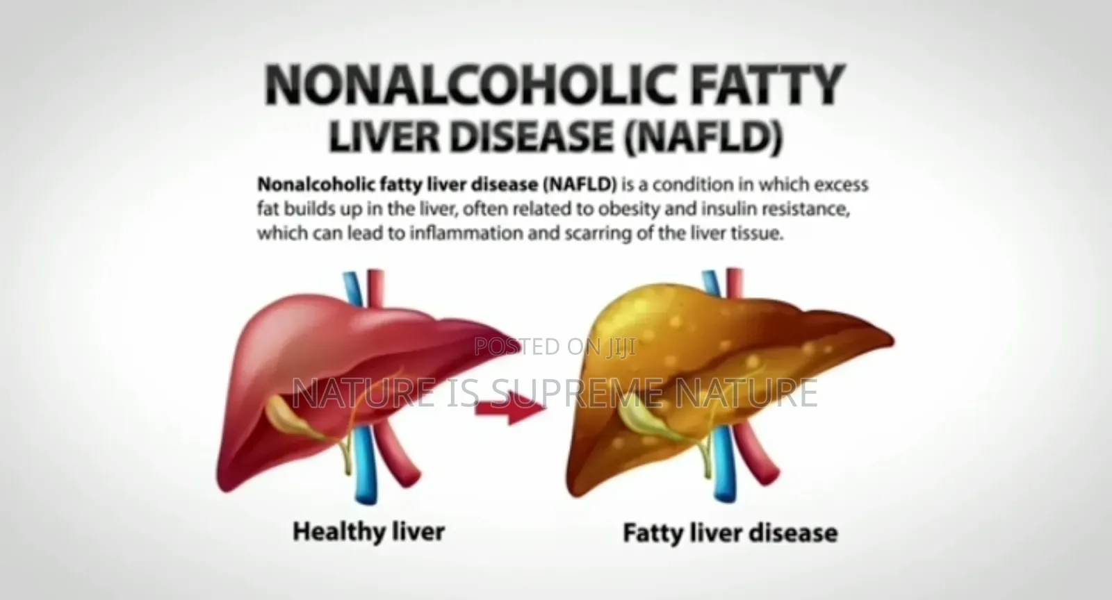 Herbs for Fatty Liver Disease