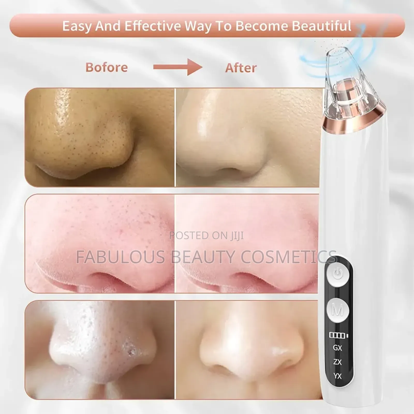Blackhead Remover, Acne Facial Pore Cleanser Suction Tool