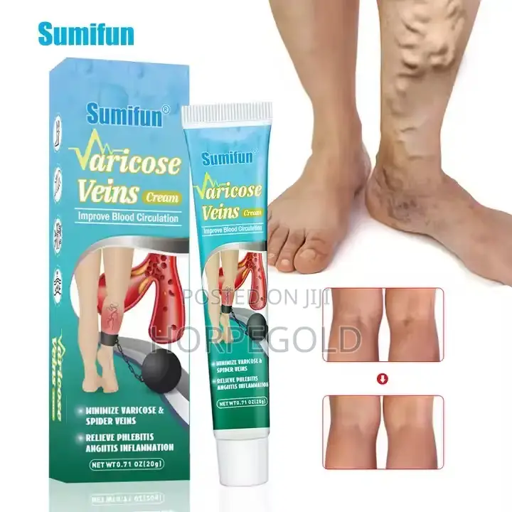 Vericose Veins Cream