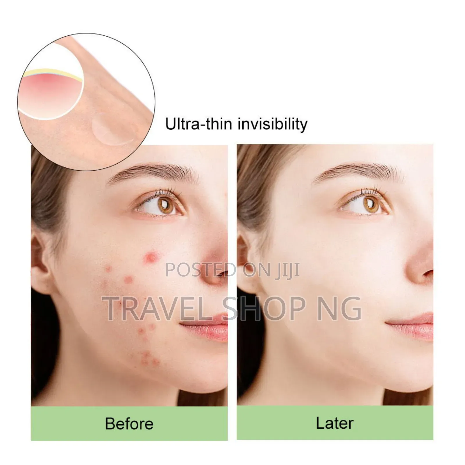 Acne Patches| Pimple Patches