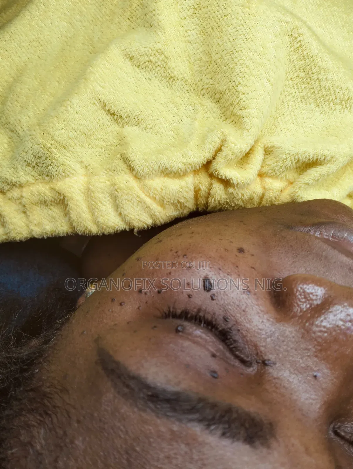 Skin Tags Removal