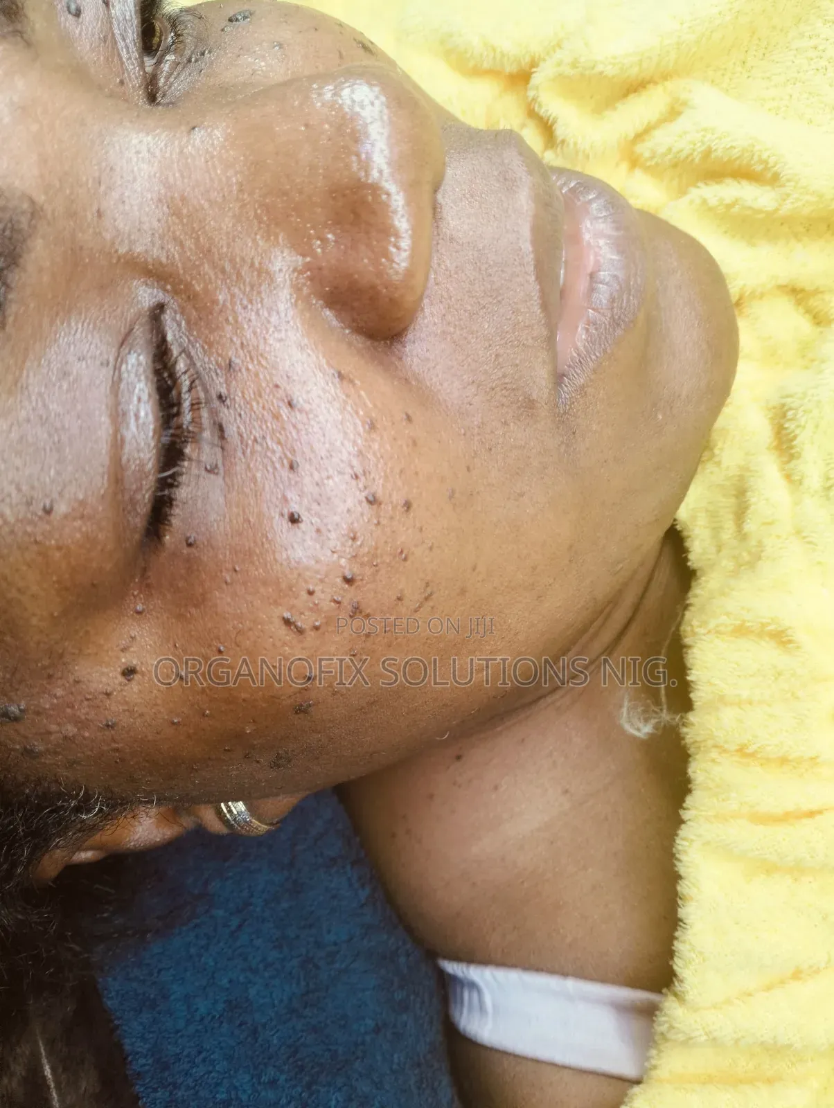 Skin Tags Removal