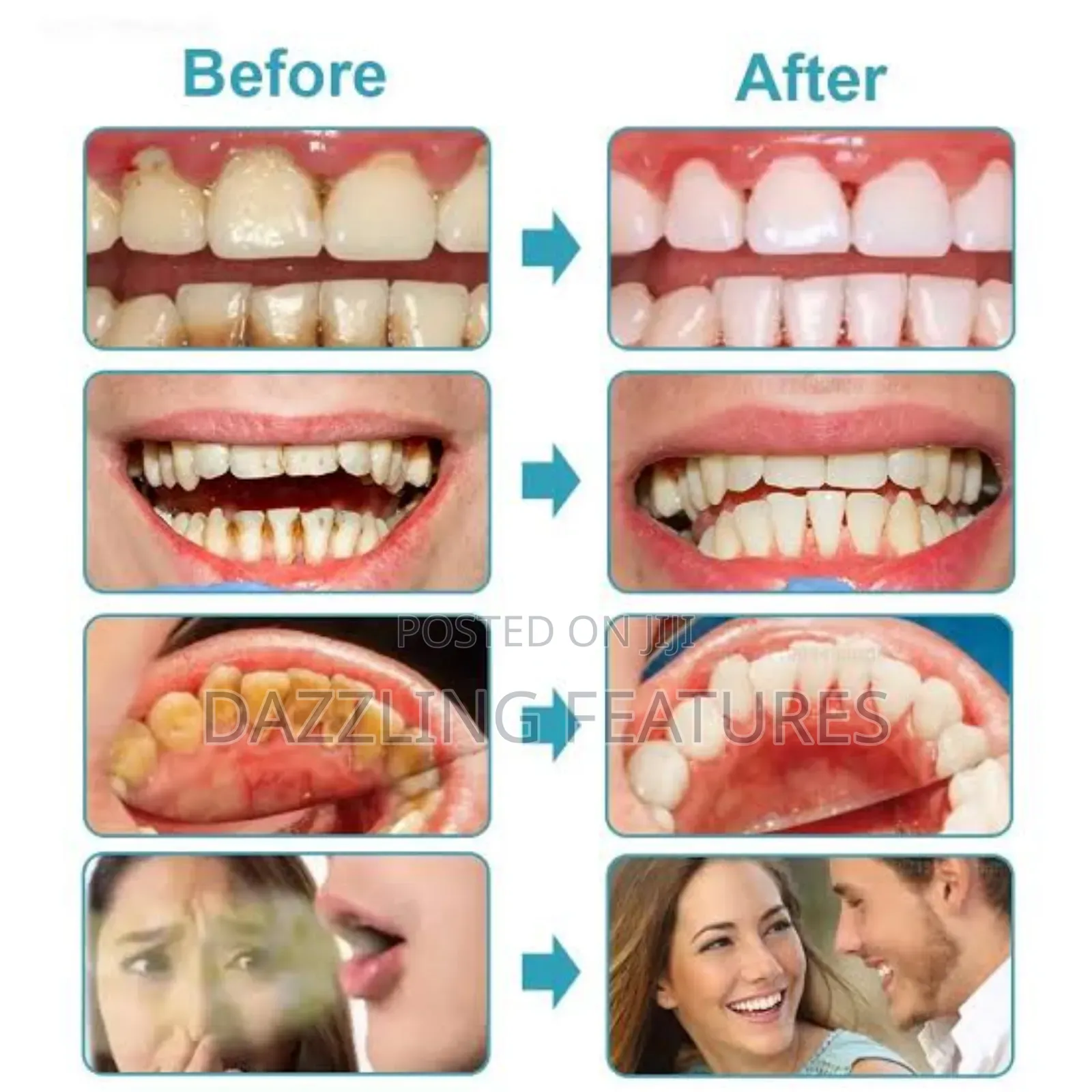 Oral Irrigator (Dental Floss)