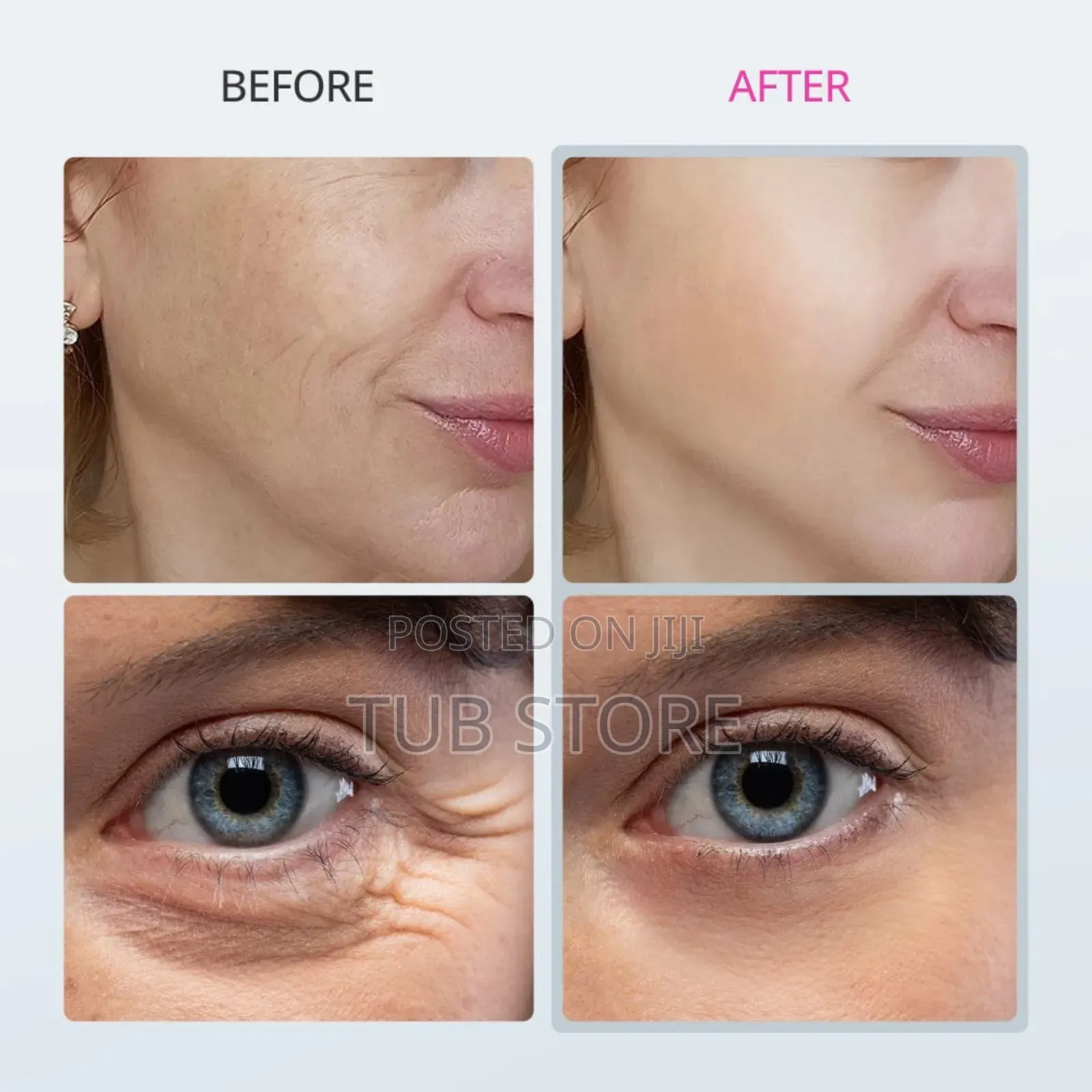 Intense Pulsed Light Wrinkles Reducing Instrument. Face Lifter Machine