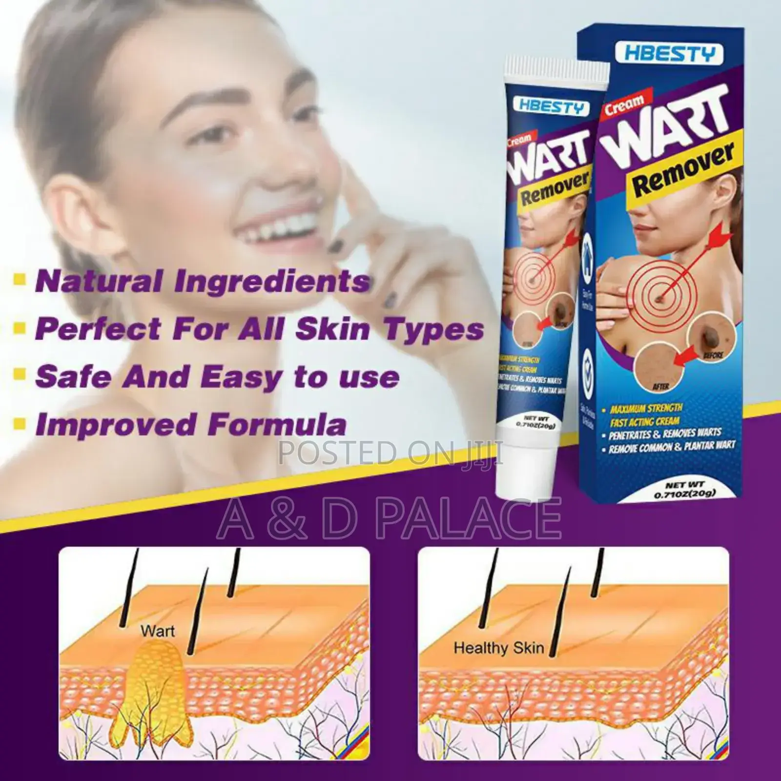 Hbesty Warts/Skin Tags Remover Cream