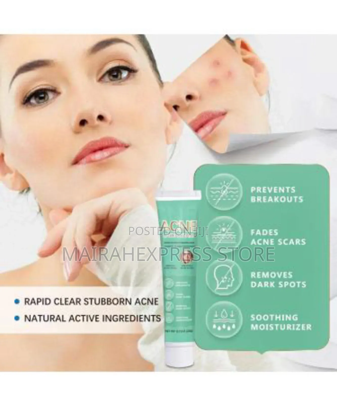 Anti Acne Face Cream