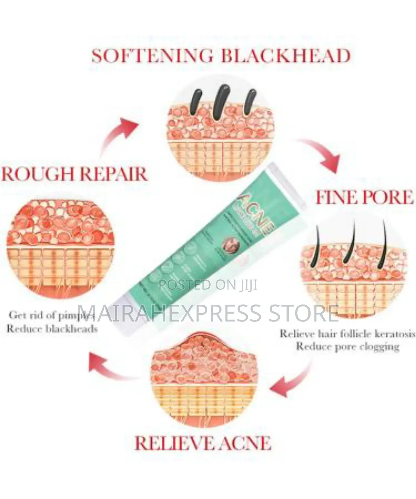 Anti Acne Face Cream