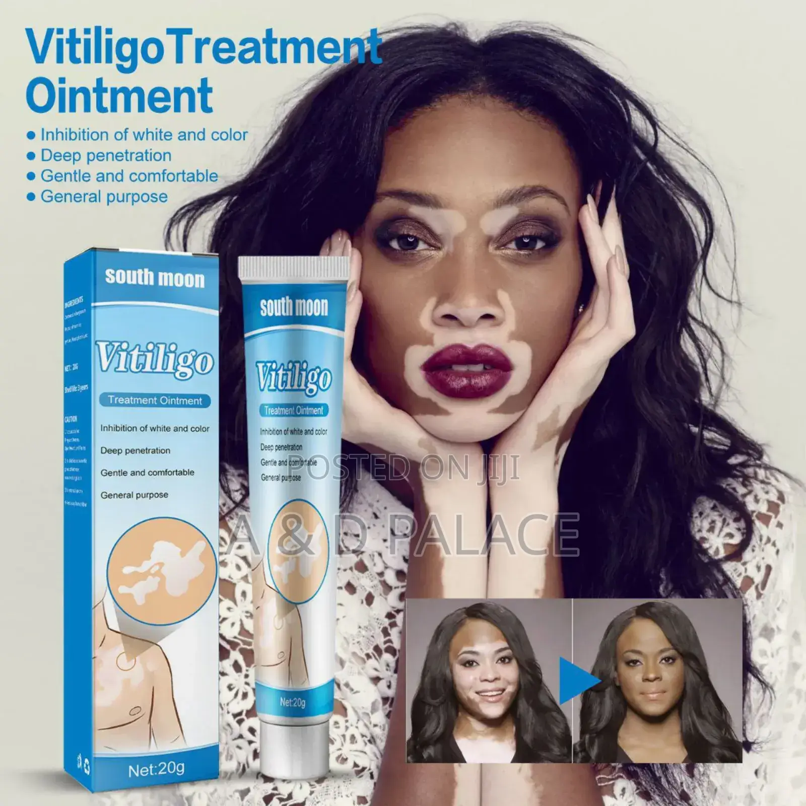 South Moon Vitiligo Cream Skin Topical Ointment