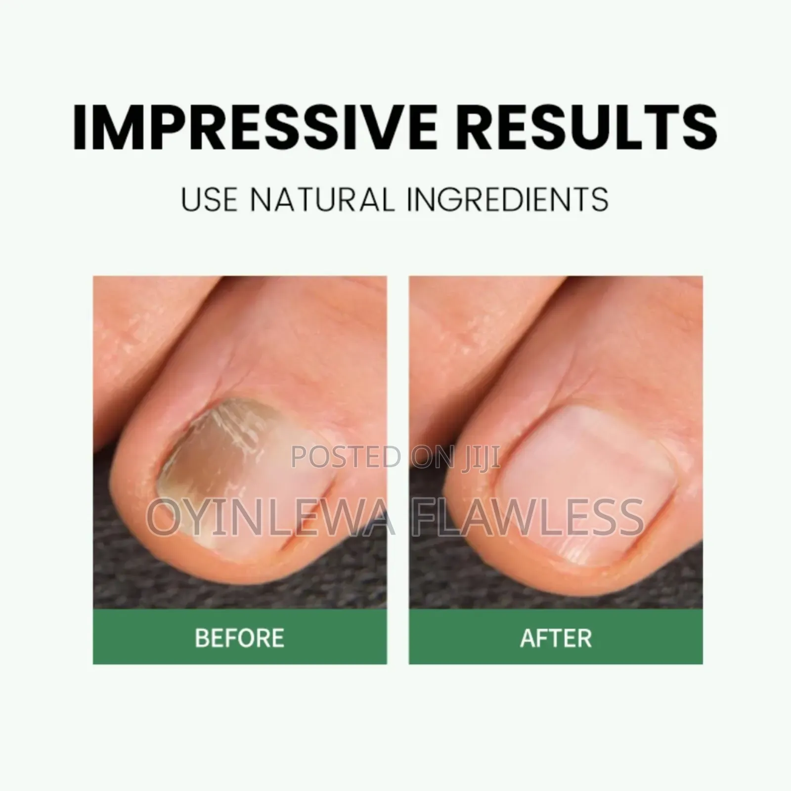 Kl Ranko Fungal Removal Anti Infection Nail Care Serum Pen