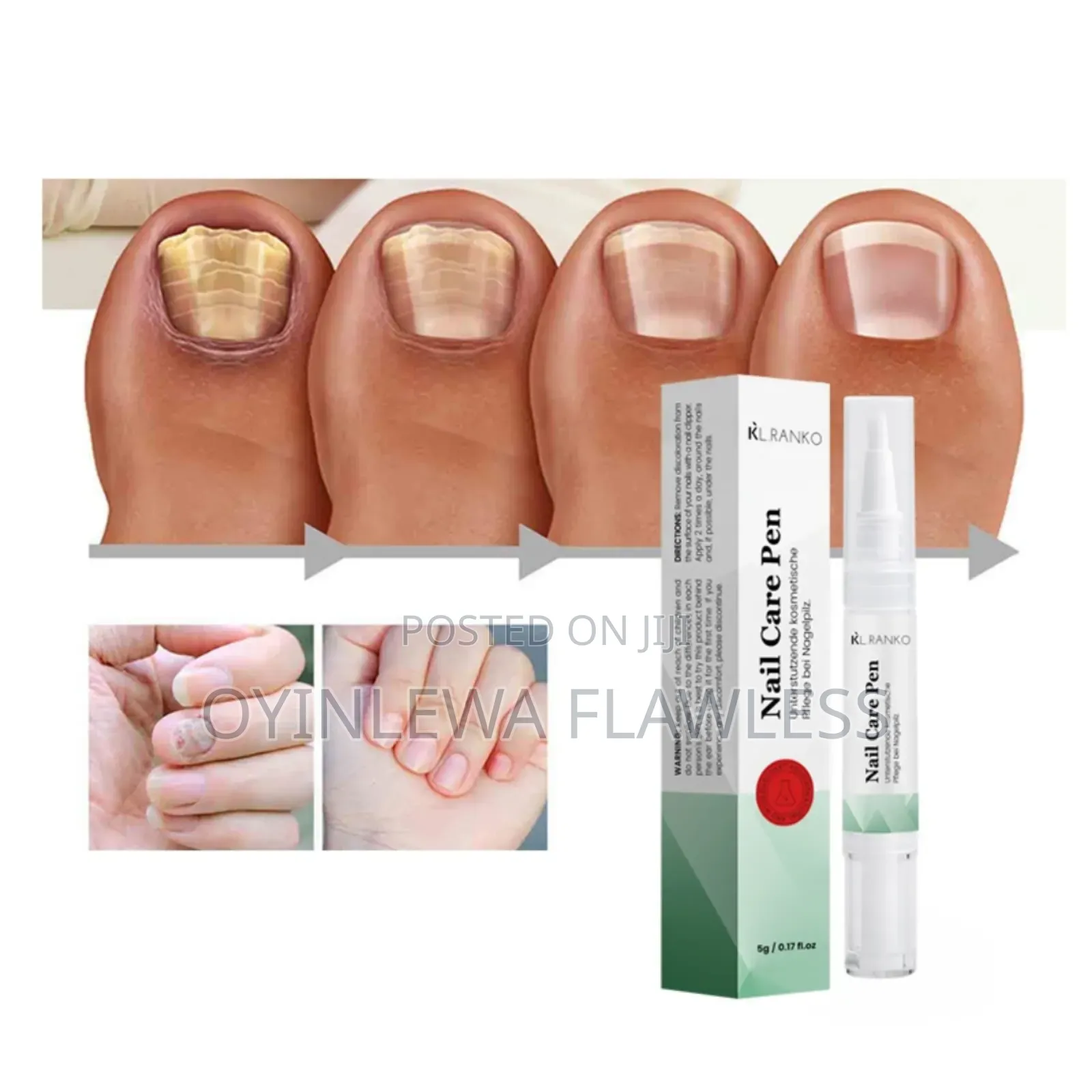 Kl Ranko Fungal Removal Anti Infection Nail Care Serum Pen