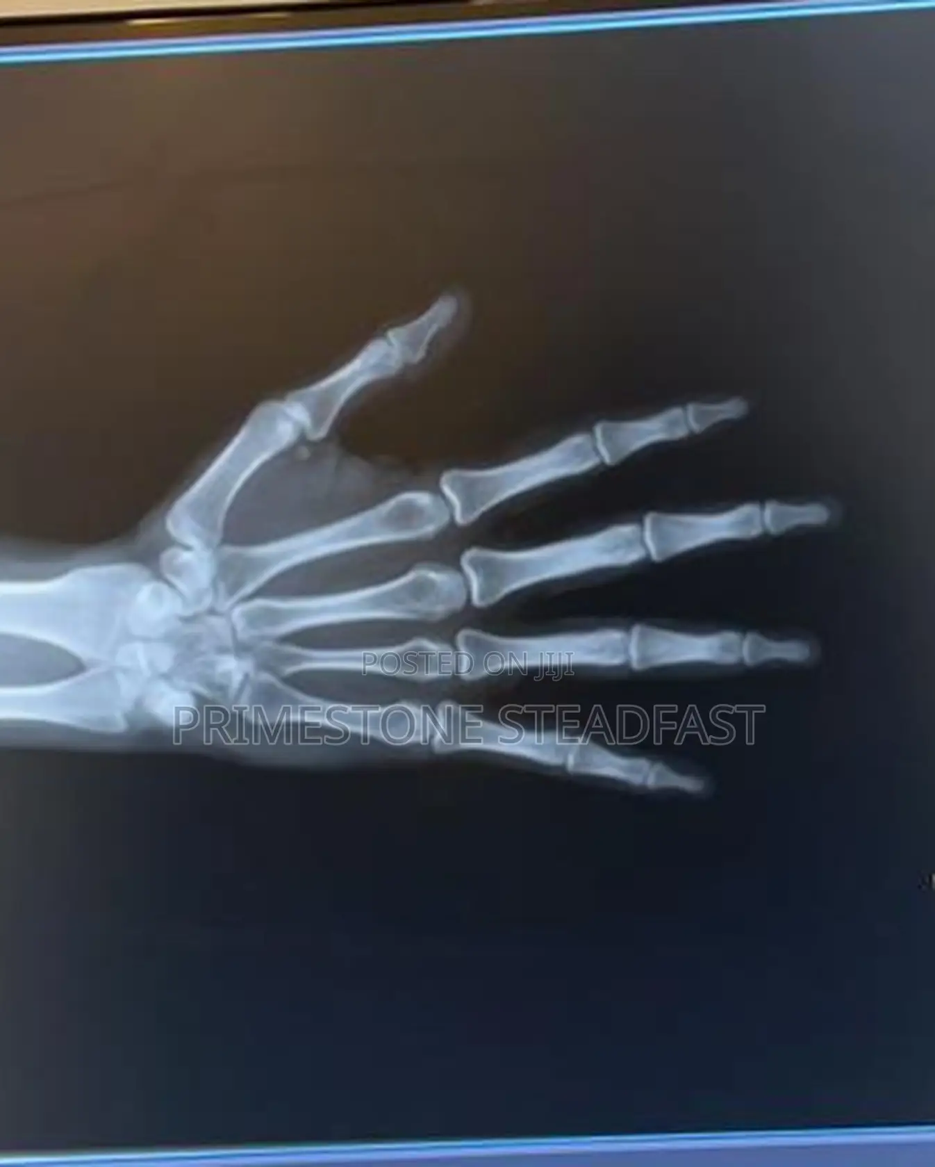 Ge Amx-4 Battery Powered Digital X-Ray Machine