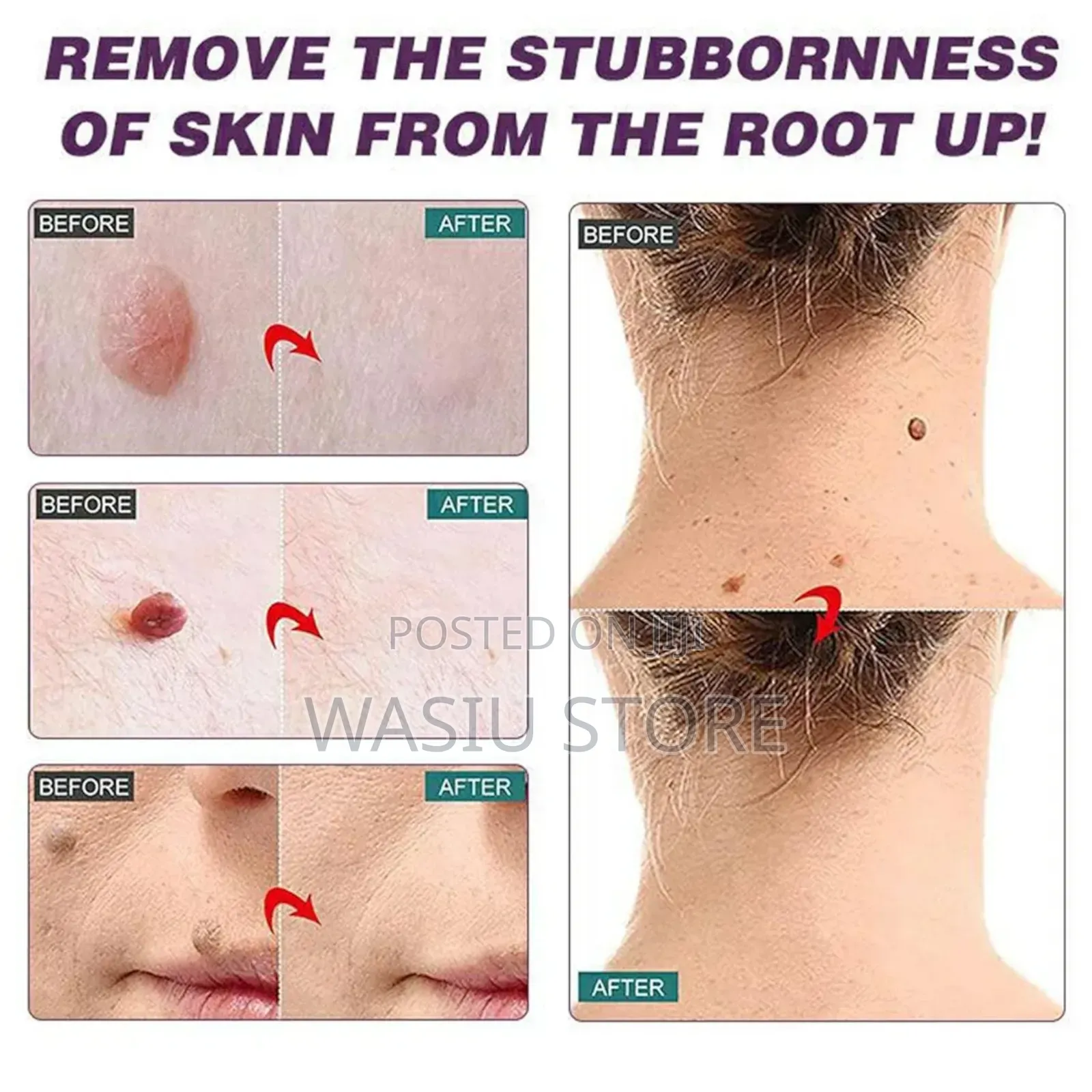 Skin Tag Removal Cream