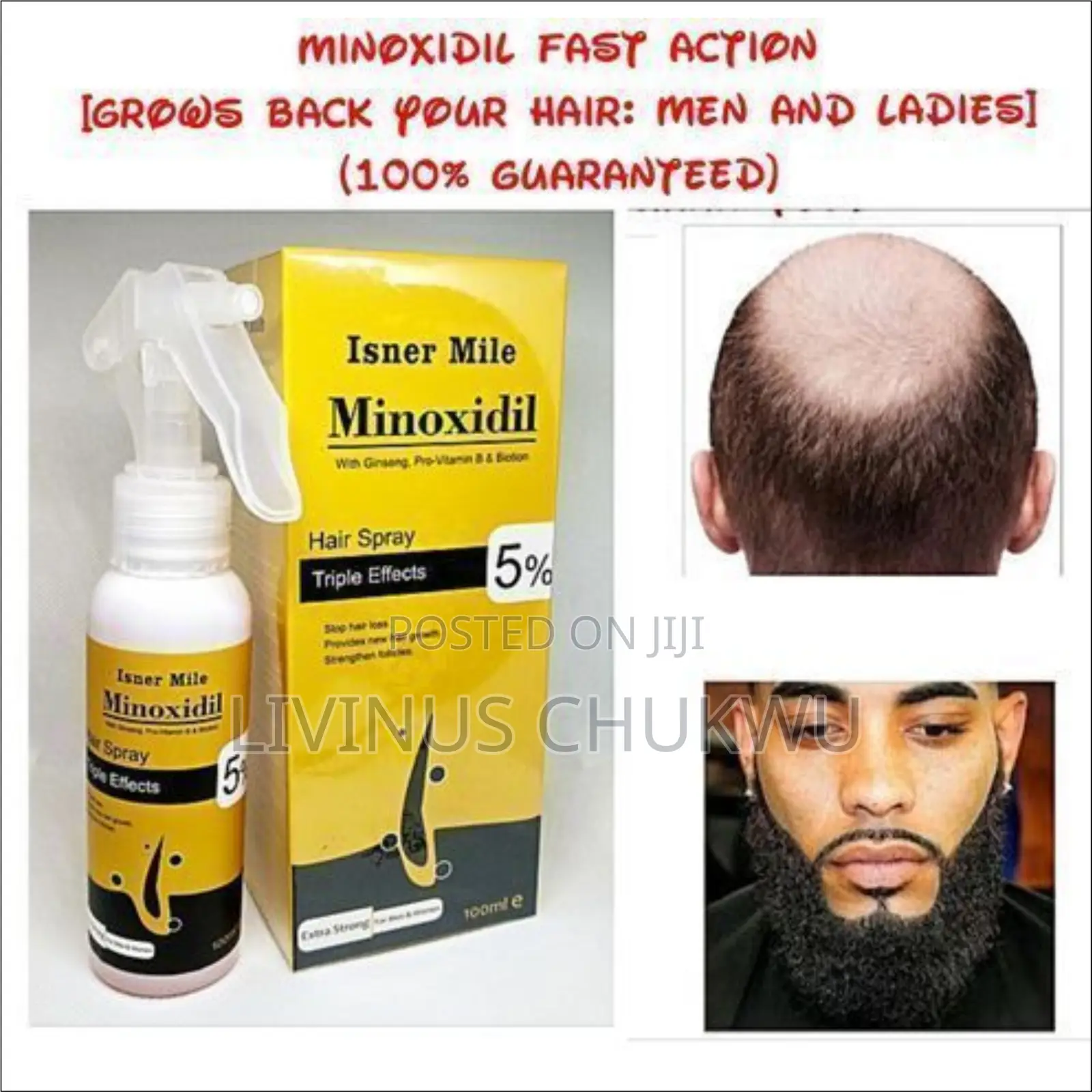 Isner Mile Minoxidil 5% Biotin Ginseng Hair Growth Plus Derma Roller