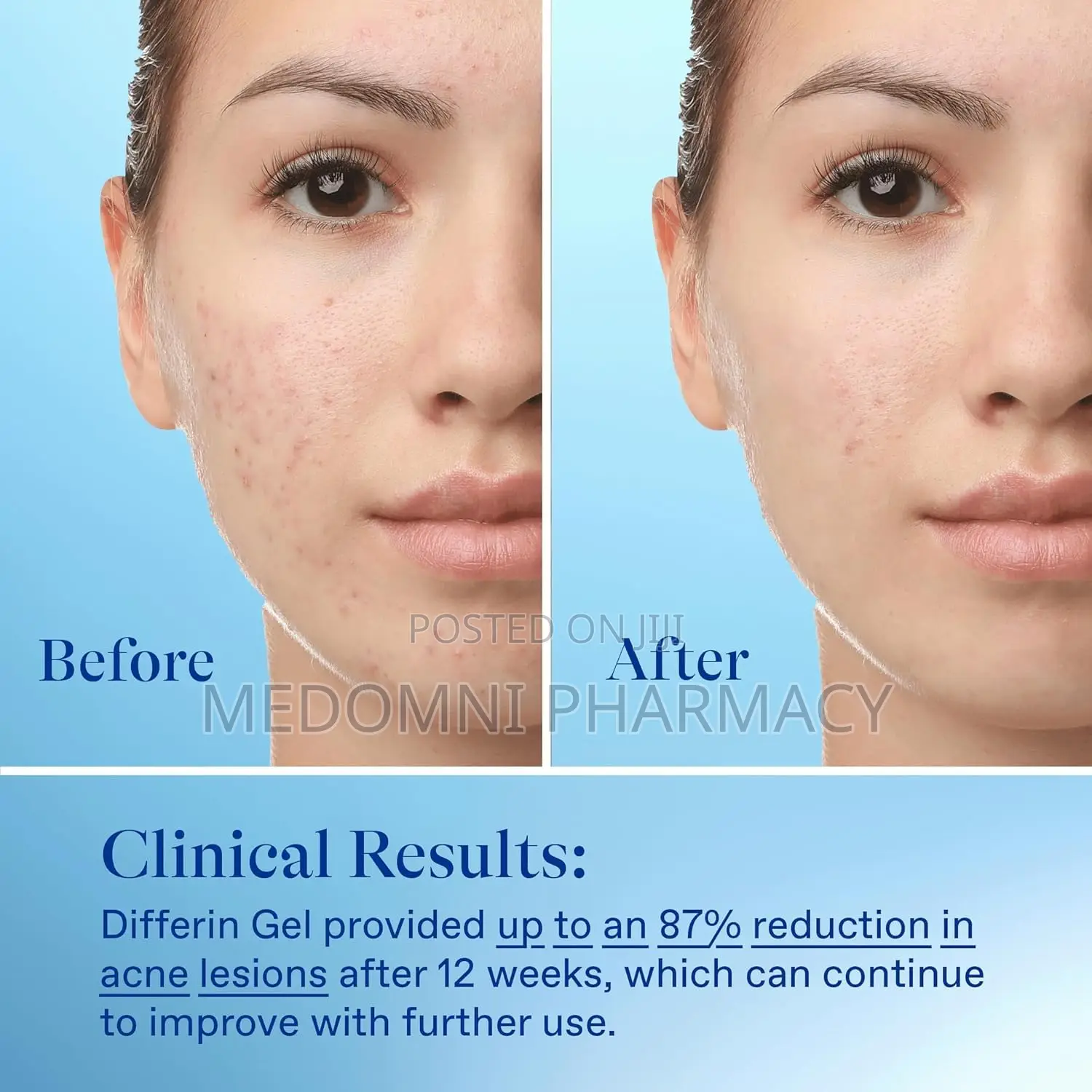 Differin Acne Treatment Gel 0.1% Adapalene – 15g