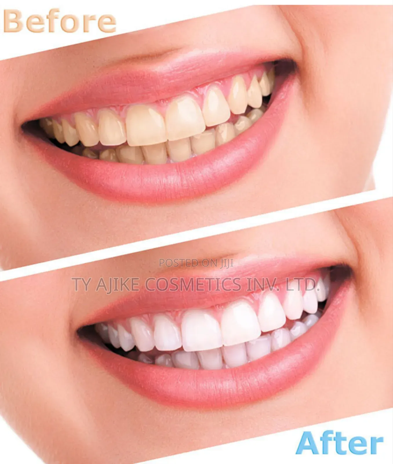 Diy Teeth Whitening Kit, Dental Care Set