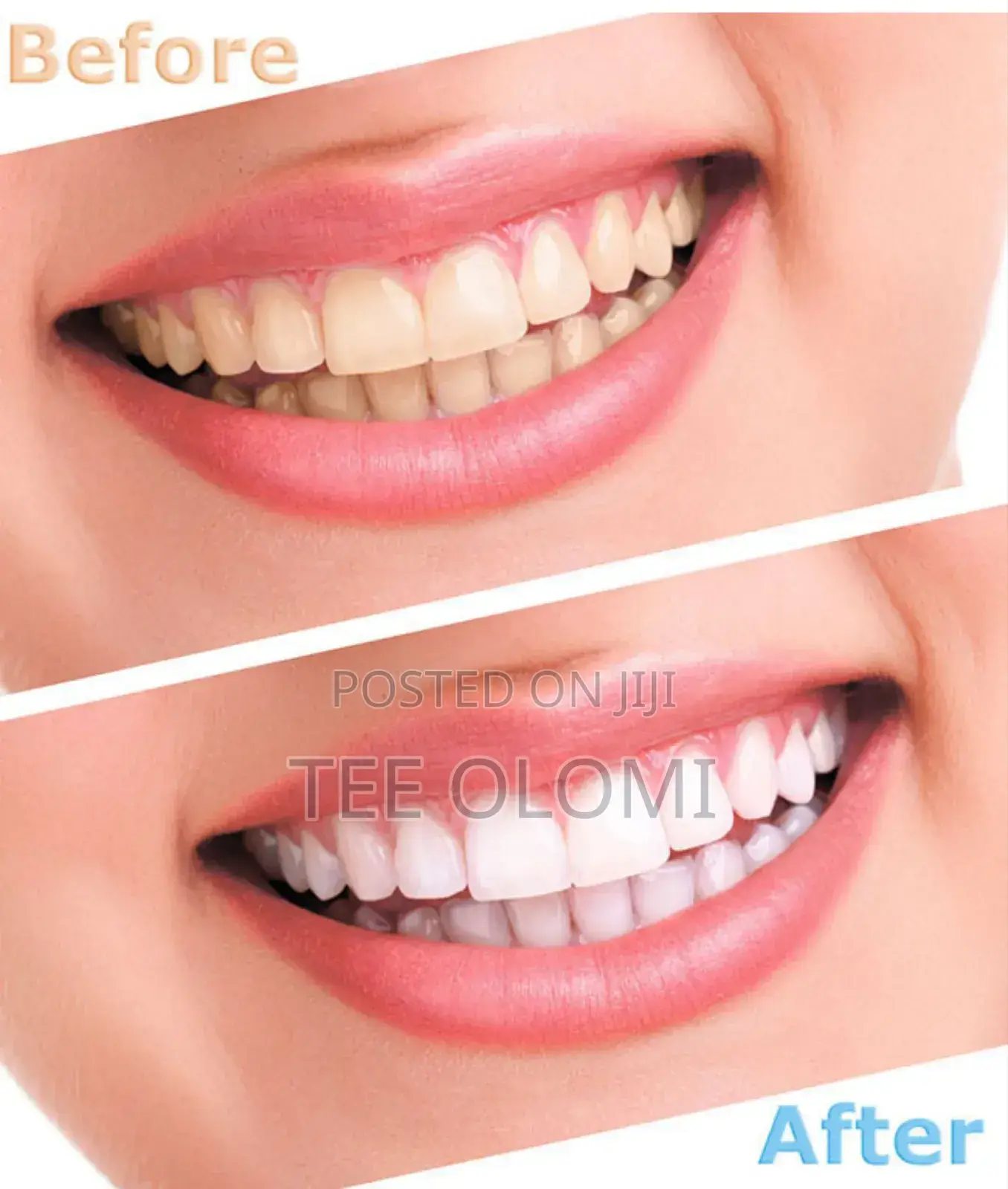 Diy Teeth Whitening Kit, Dental Care Set