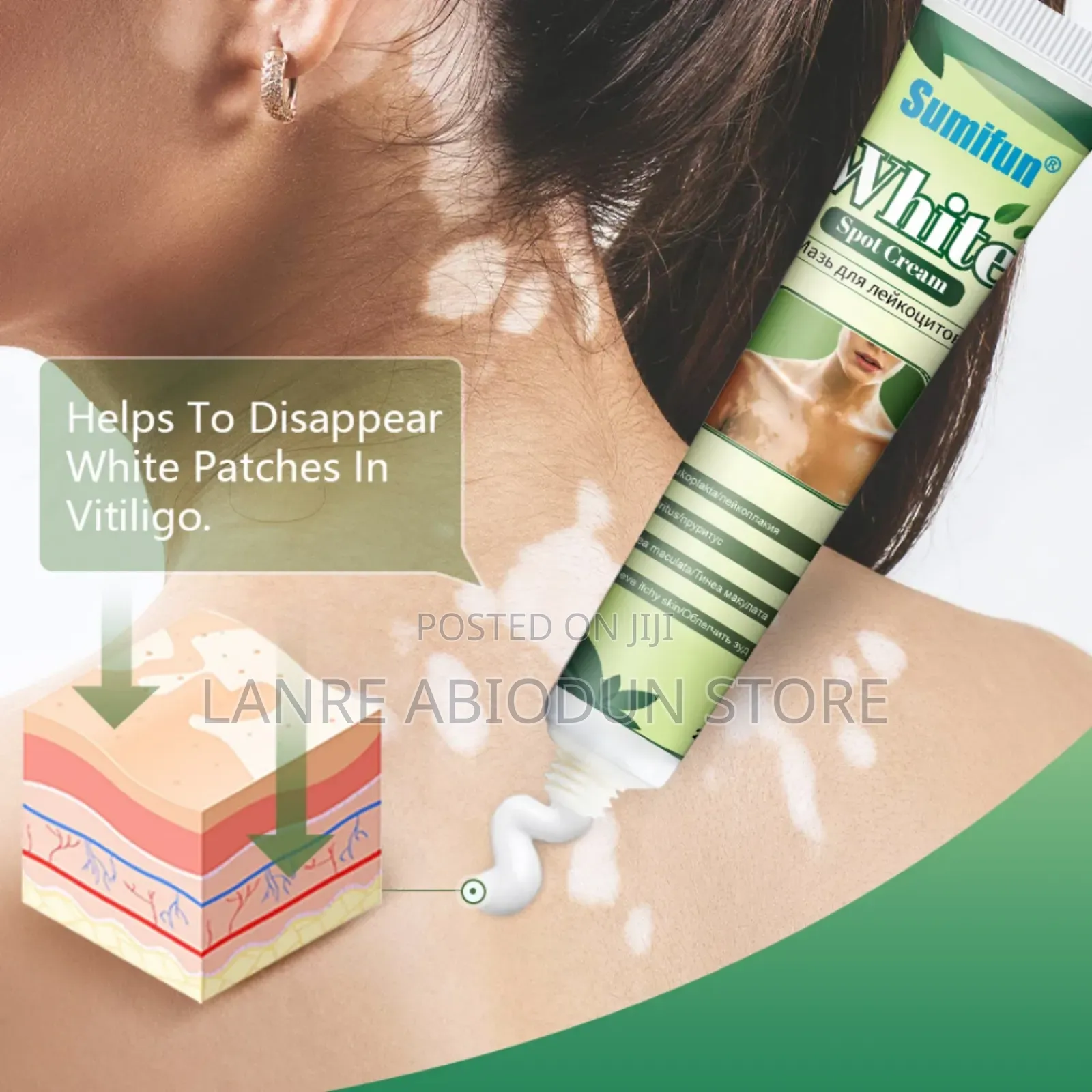 Vitiligo Care Cream