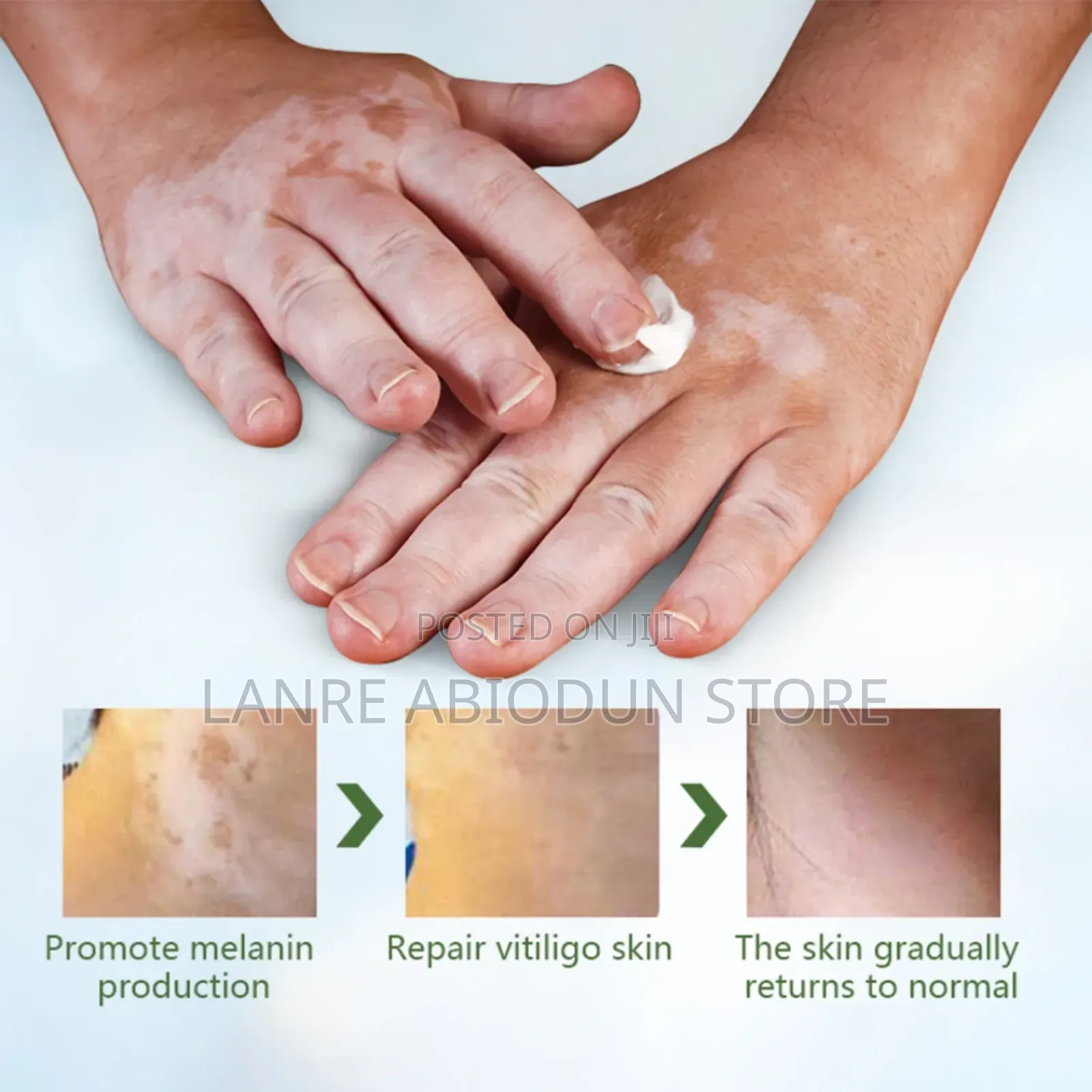 Vitiligo Care Cream