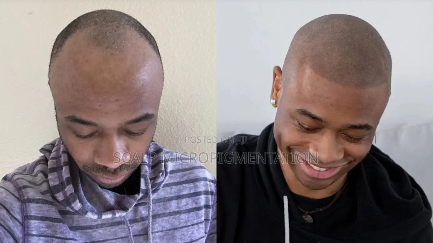Scalp Micropigmentation Smp - Hair Loss, Baldness And Alopecia