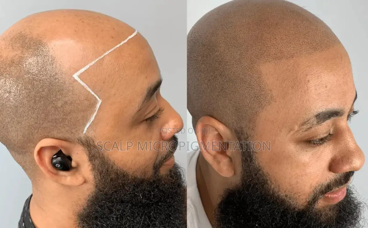 Scalp Micropigmentation Smp - Hair Loss, Baldness And Alopecia
