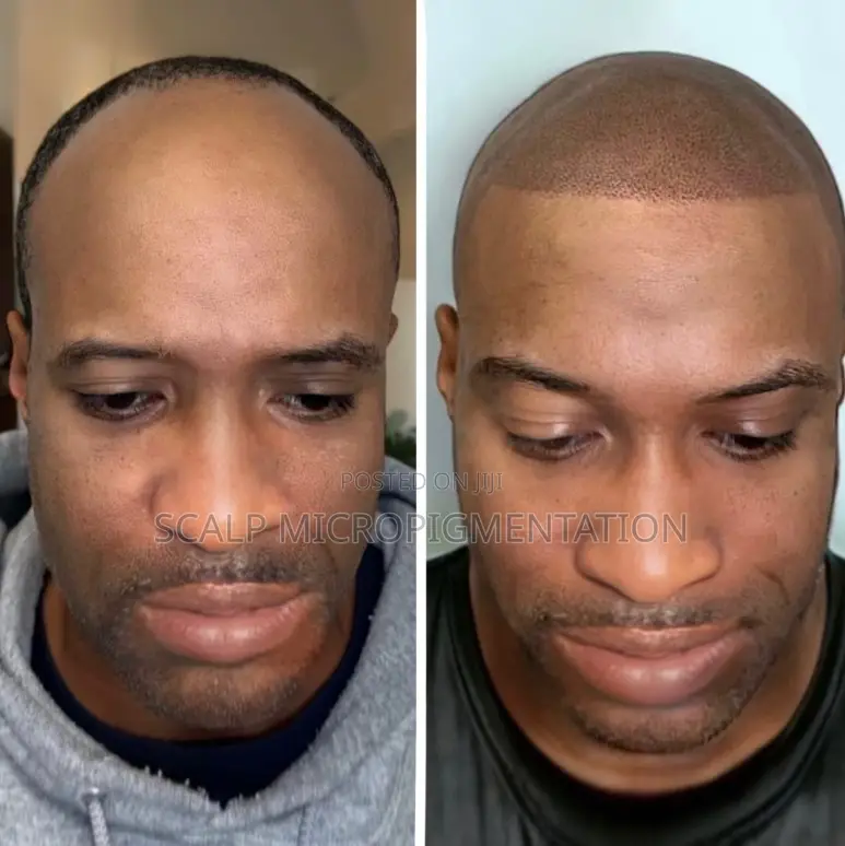 Scalp Micropigmentation Smp - Hair Loss, Baldness And Alopecia