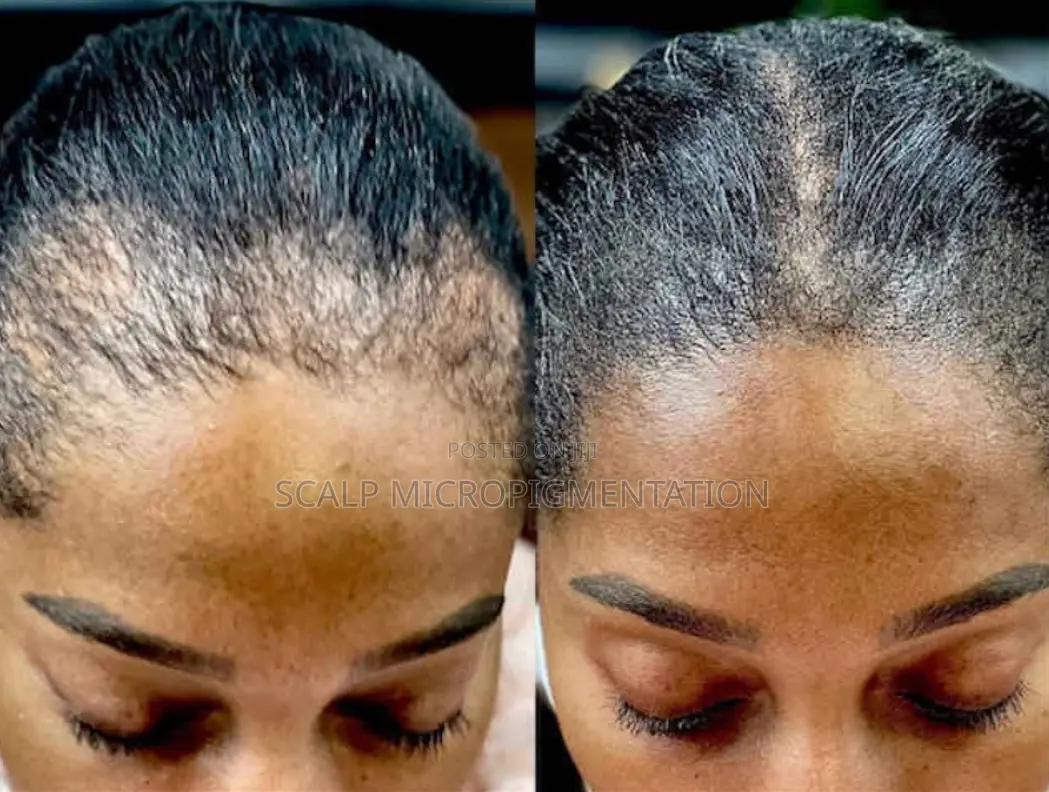Scalp Micropigmentation Smp - Hair Loss, Baldness And Alopecia