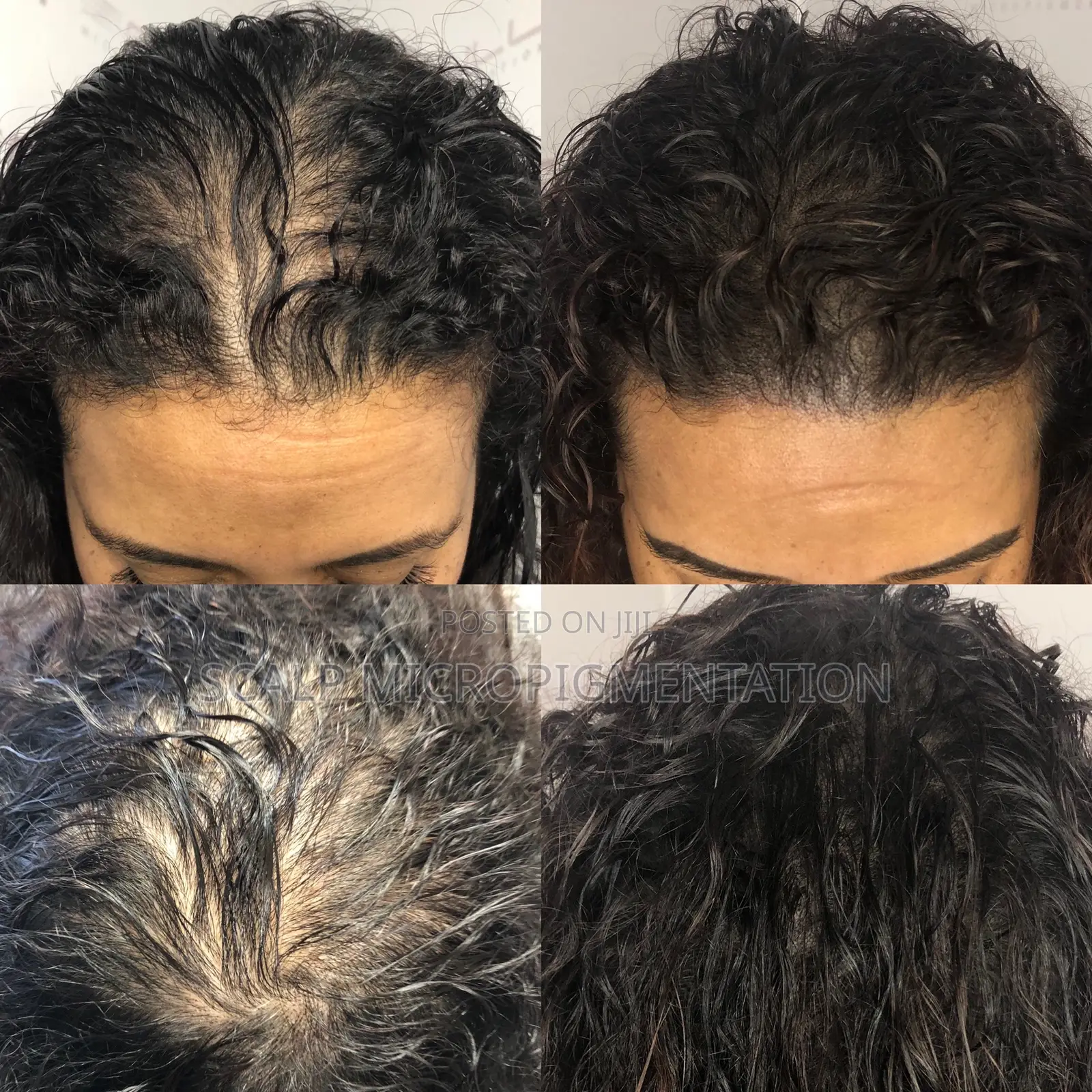 Scalp Micropigmentation Smp - Hair Loss, Baldness And Alopecia