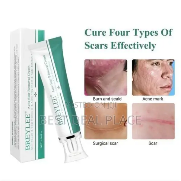 Acne Scar Removal Cream / Acne Treatment /Stretch Mark Cream.