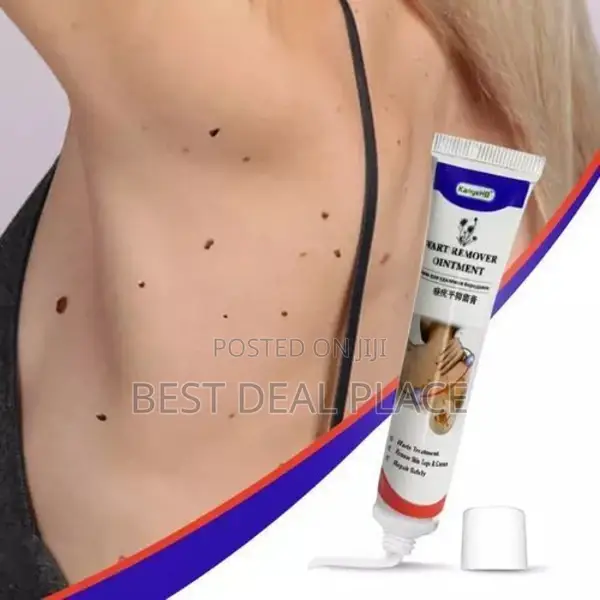 Warts Remover Herbal Treatment Ointment