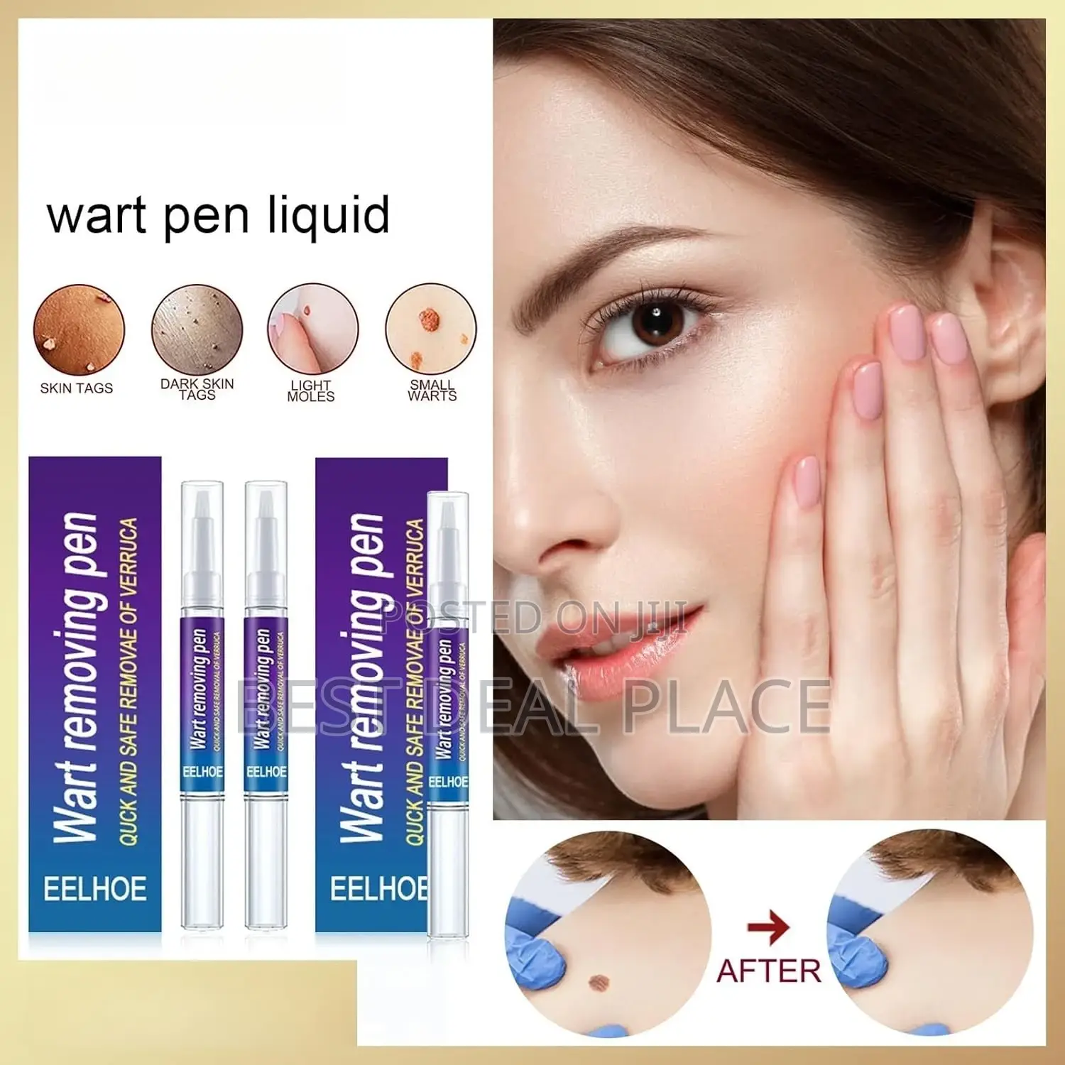 Eelhoe Doctor Proven Verruca Wart Removing Pen
