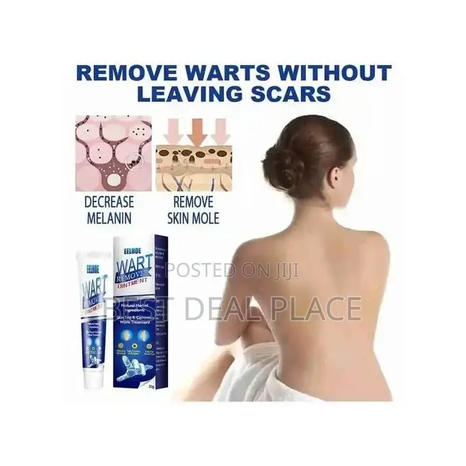 Effective Herbal Wart Removal Ointment Cream