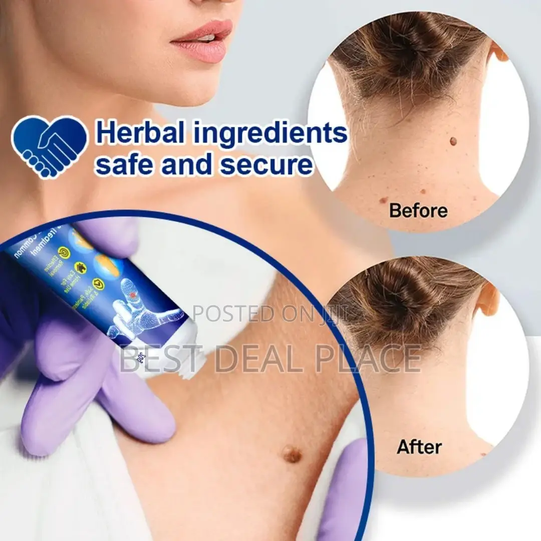 Sumifun Natural Herbal Warts Remover Treatment Ointment